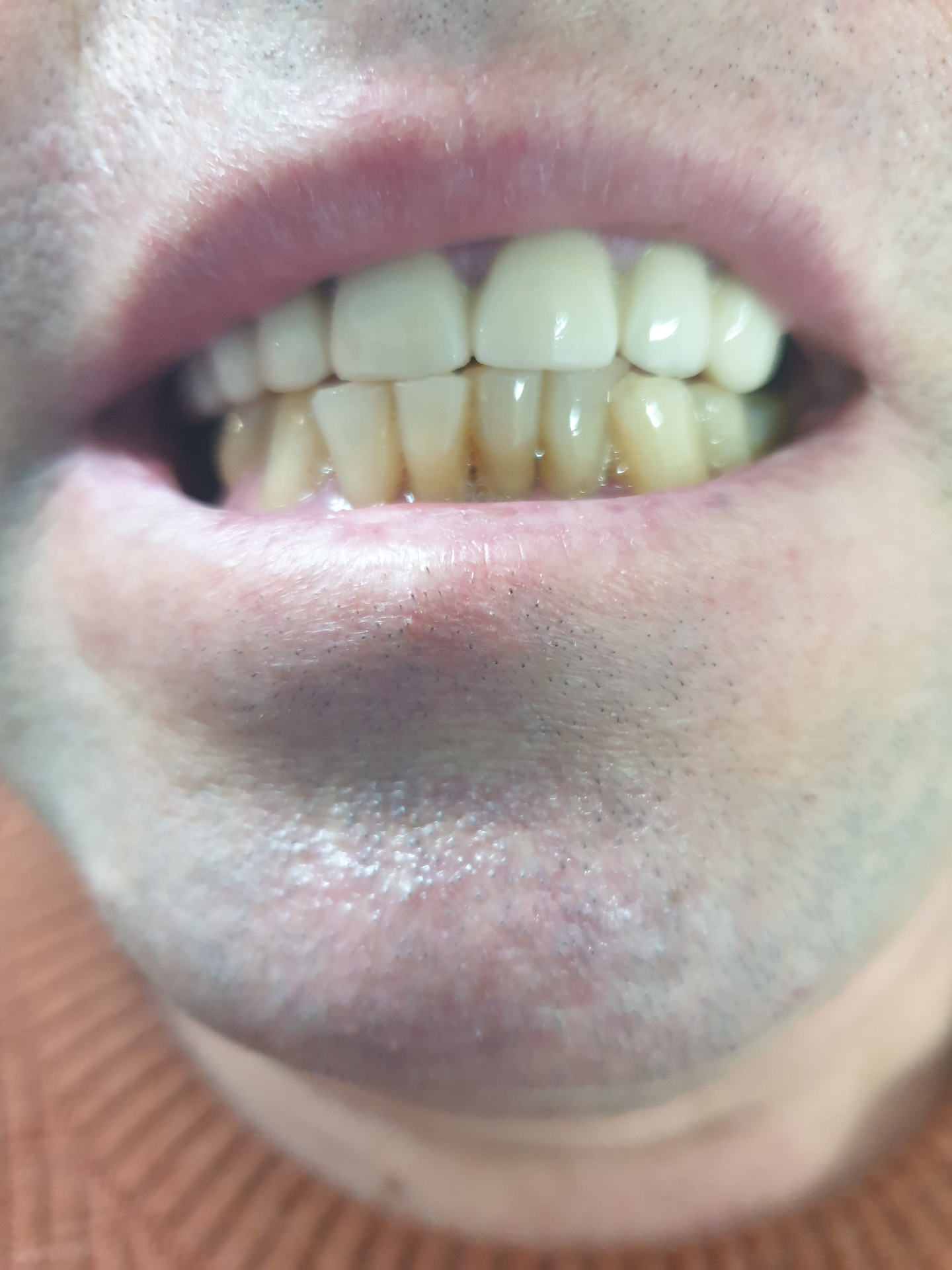 Reabilitare orală complexă - după