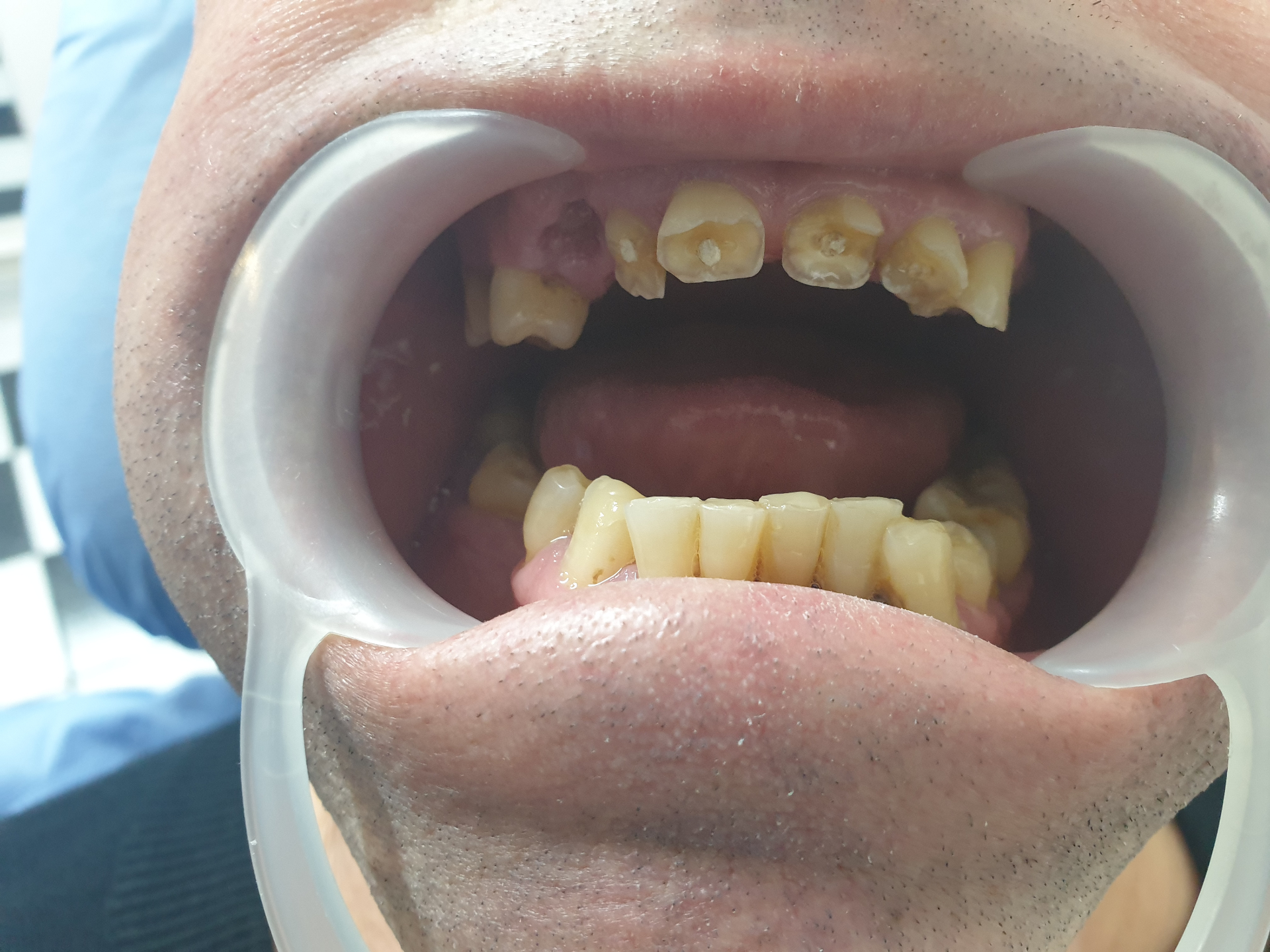 Reabilitare orală complexă - înainte
