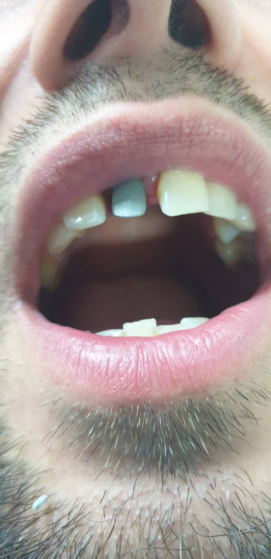 Restaurare dinte frontal - înainte